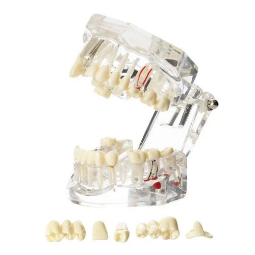 Dental Teeth Model for Implant Restoration Bridge - Teaching Study Aid for Dentists